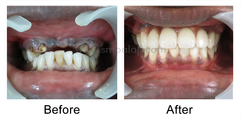 Approach For Dental Case